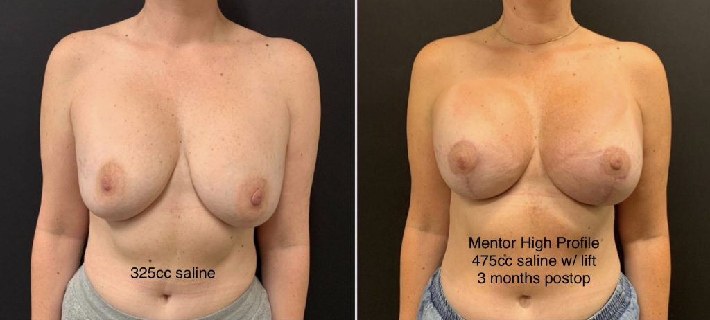 BREAST REVISION Before & After Case Number 0004