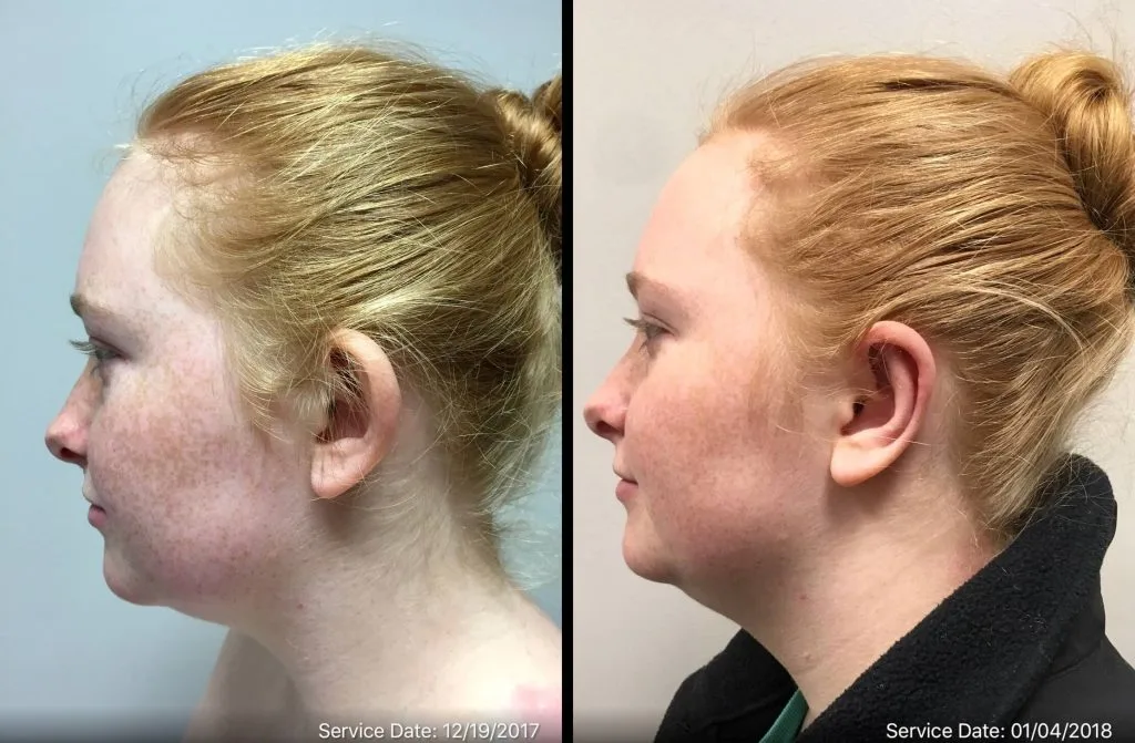 EAR SHAPING/OTOPLASTY Before & After Case Number 0001