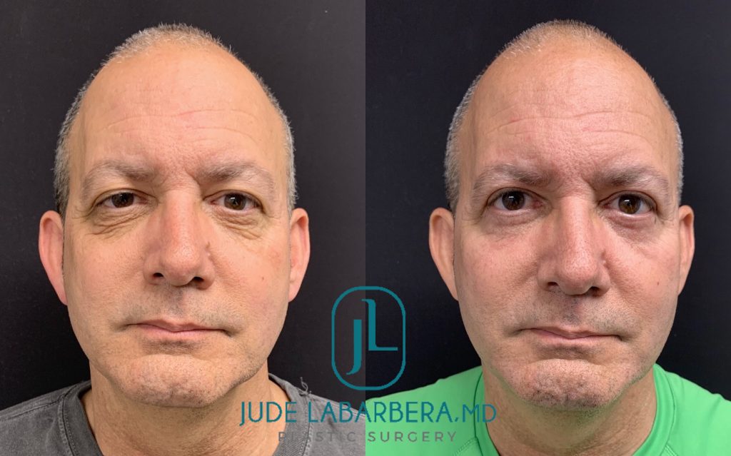 FACELIFT AND LOWER EYELID PROCEDURE Before & After Case Number 00011