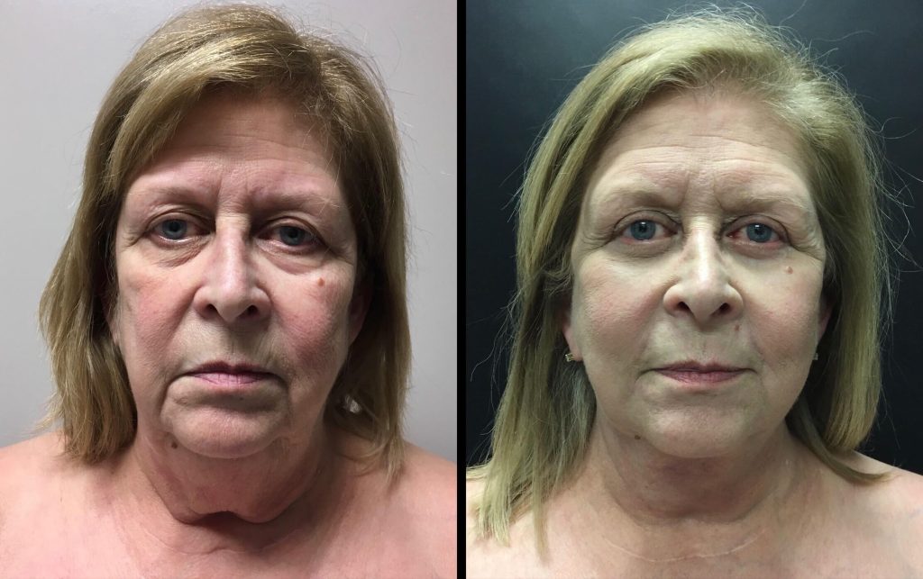 FACELIFT AND LOWER EYELID PROCEDURE Before & After Case Number 00013