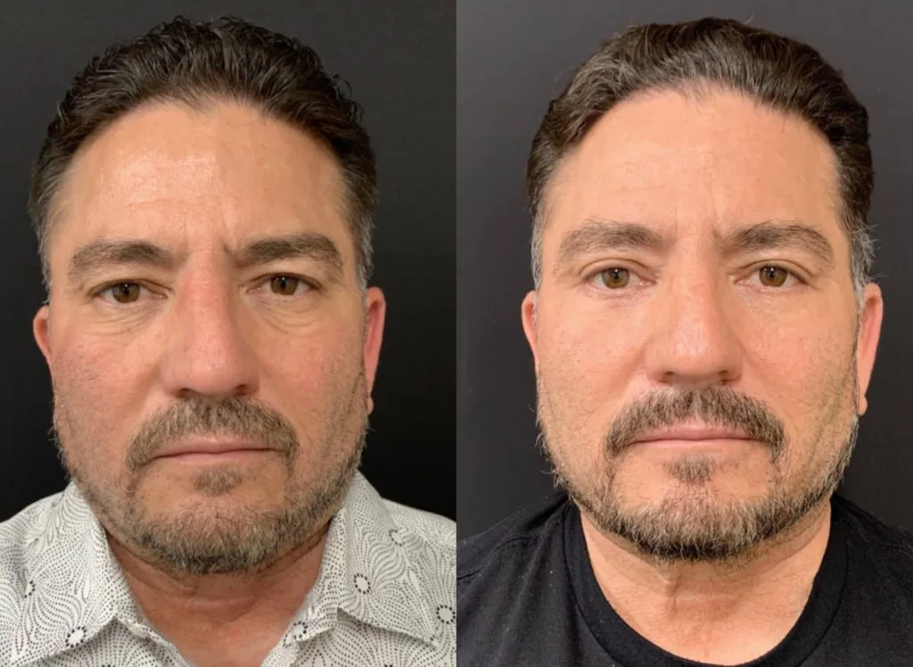 Facelift Before & After case 4