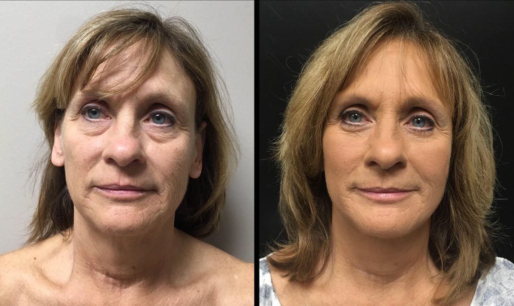 FACELIFT Before & After Case Number 0002