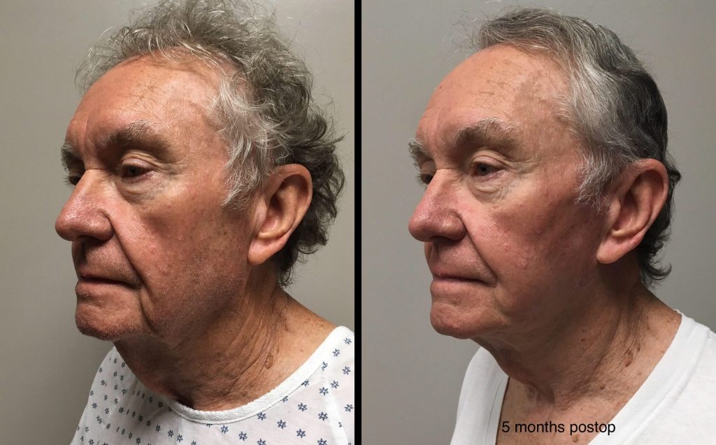 FACELIFT Before & After Case Number 0004