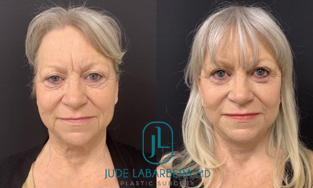 FACELIFT Before & After Case Number 0007