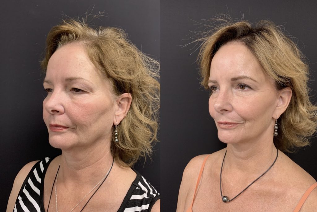 FACELIFT Before & After Case Number 0008