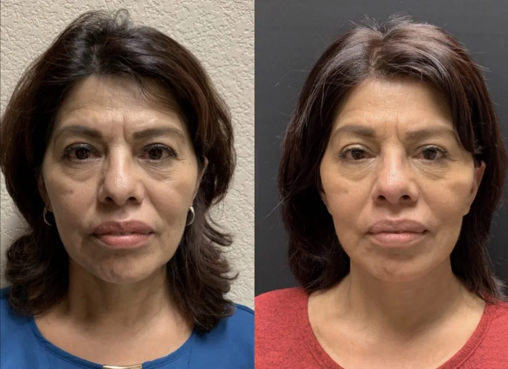 FACELIFT & NeckLift Before & After Case Number 0007