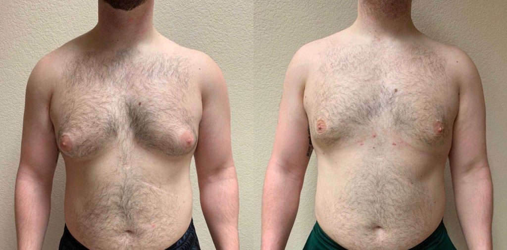 GYNECOMASTIA Before & After Case Number 0001