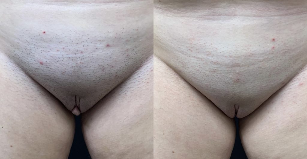 LABIAPLASTY Before & After Case Number 0002