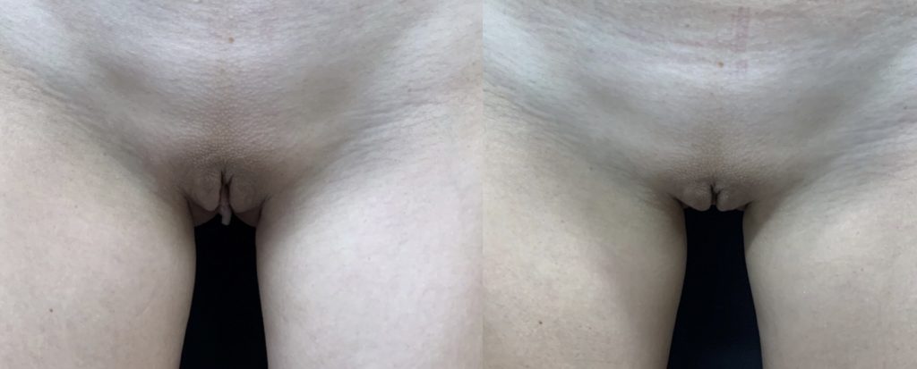 LABIAPLASTY Before & After Case Number 0005
