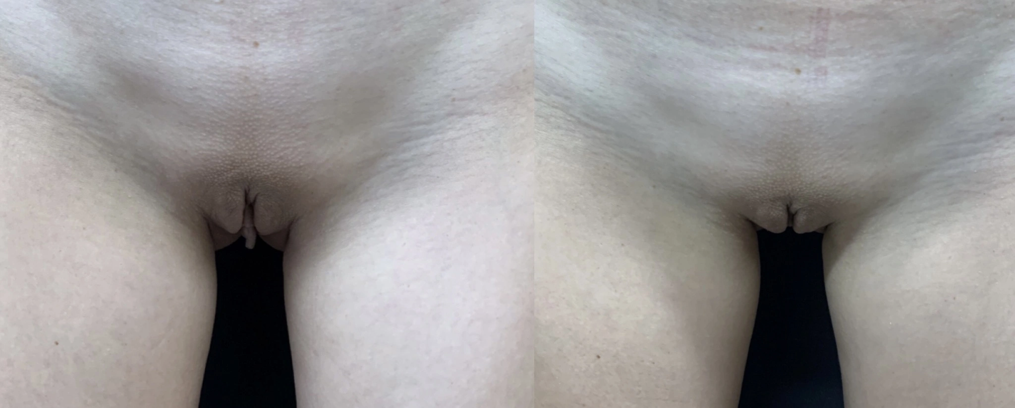 LABIAPLASTY Before & After Case Number 0005