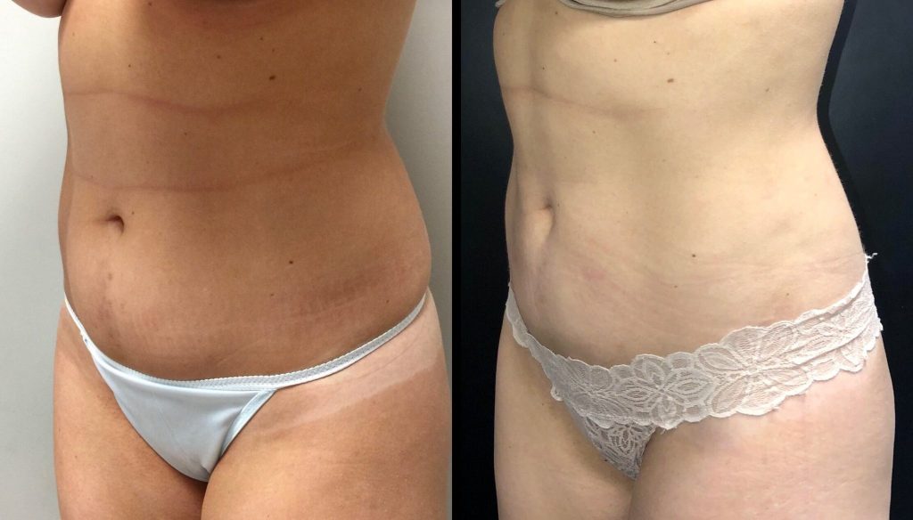 LIPOSUCTION Before & After Case Number 0002