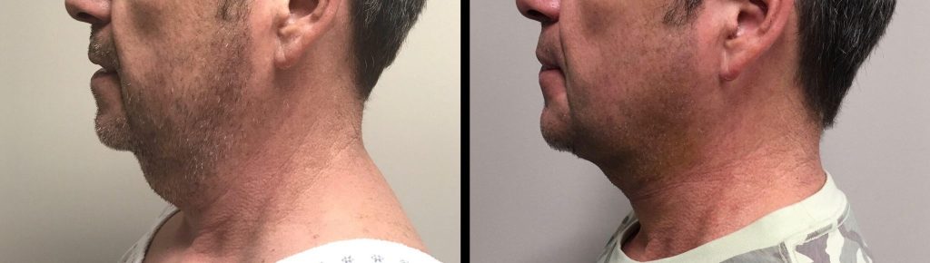 LIPOSUCTION Before & After Case Number 0003