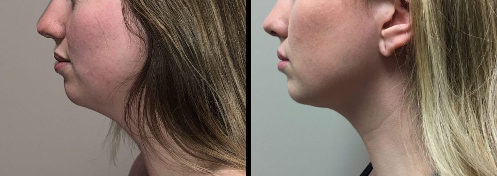 LIPOSUCTION Before & After Case Number 0004