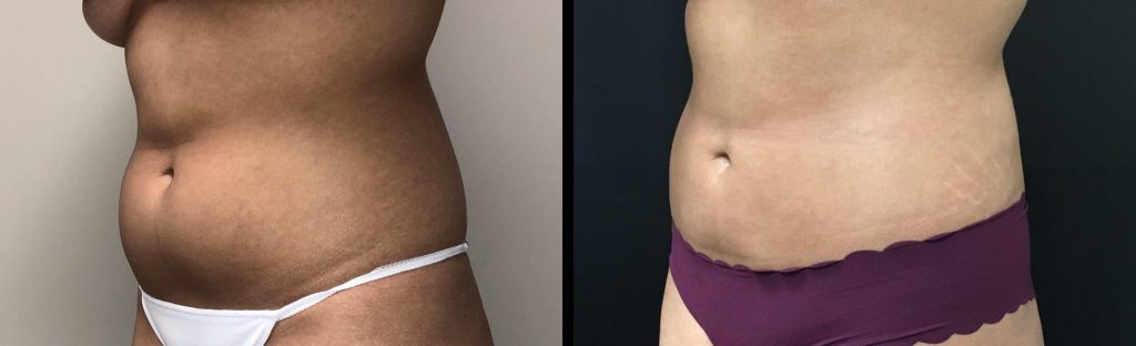 LIPOSUCTION Before & After Case Number 0005