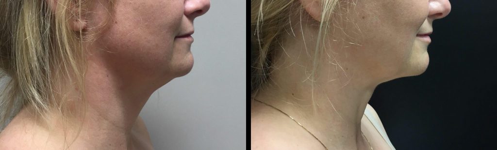LIPOSUCTION Before & After Case Number 0006
