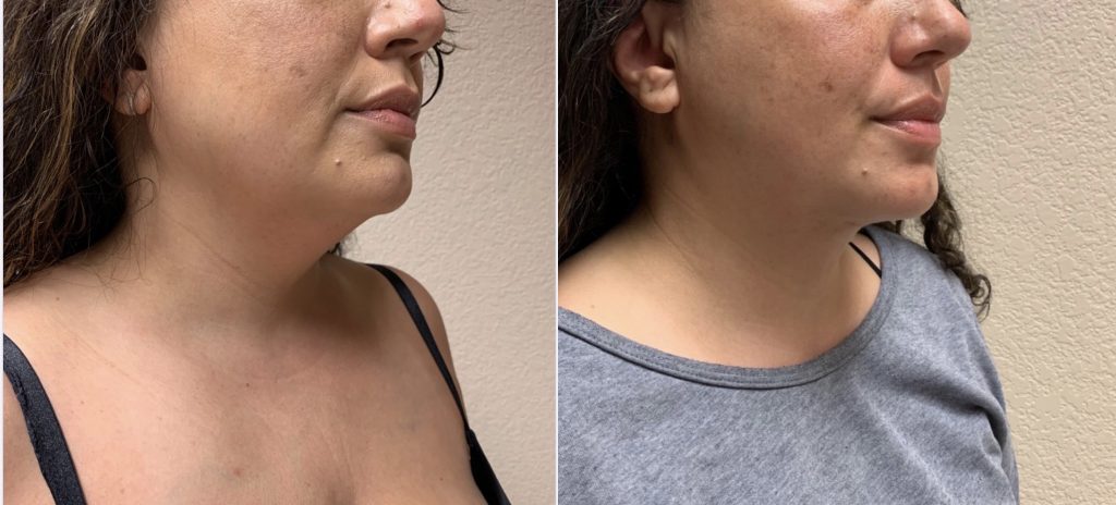 LIPOSUCTION Before & After Case Number 0007