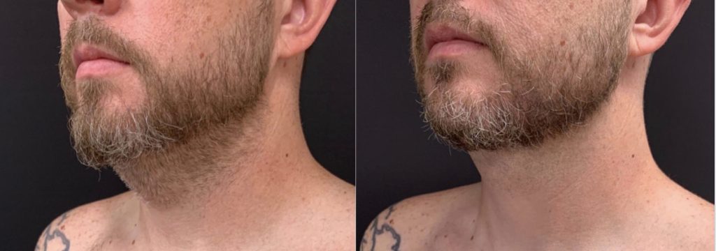 LIPOSUCTION OF SUBMENTAL OR DOUBLE CHIN AREA Before & After Case Number 0008