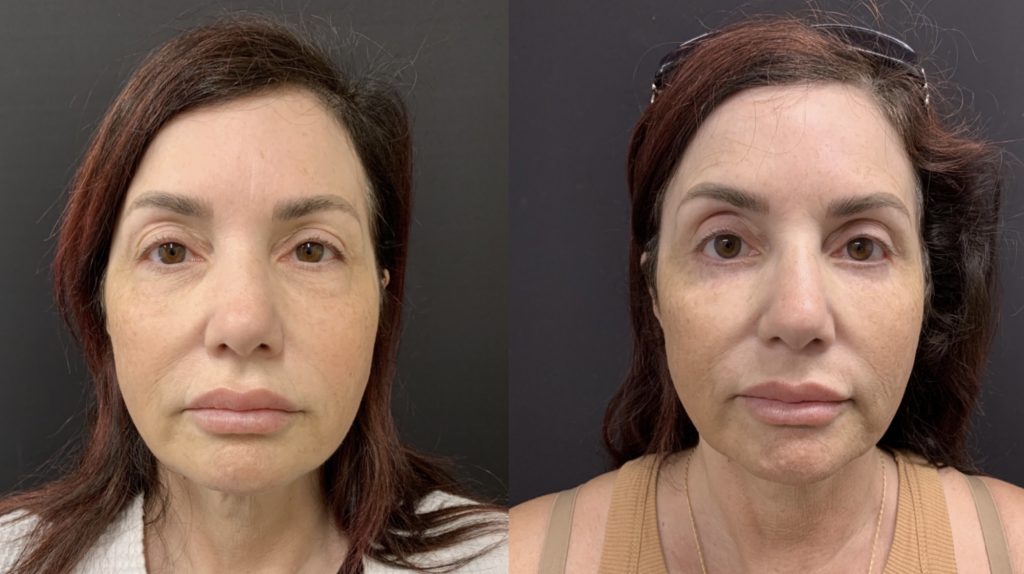 LOWER BLEPHAROPLASTY – LOWER EYELID SURGERY Before & After Case Number 00014