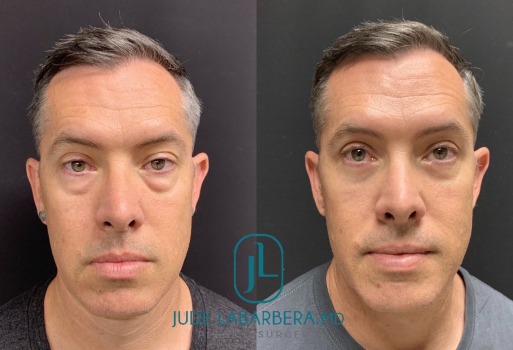 Lower EYELID Lift Before & After Case Number 00016