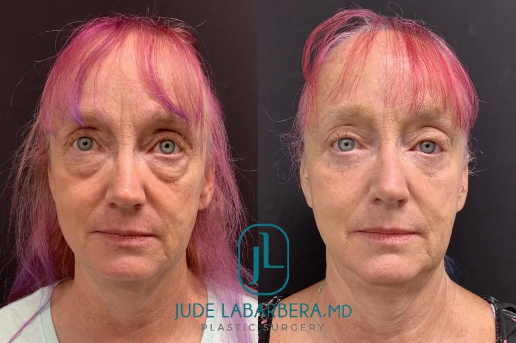LOWER EYELID SURGERY Before & After Case Number 0009