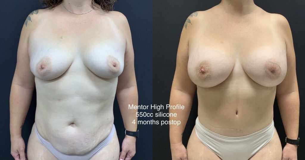 MOMMY MAKEOVER Before & After Case Number 00039