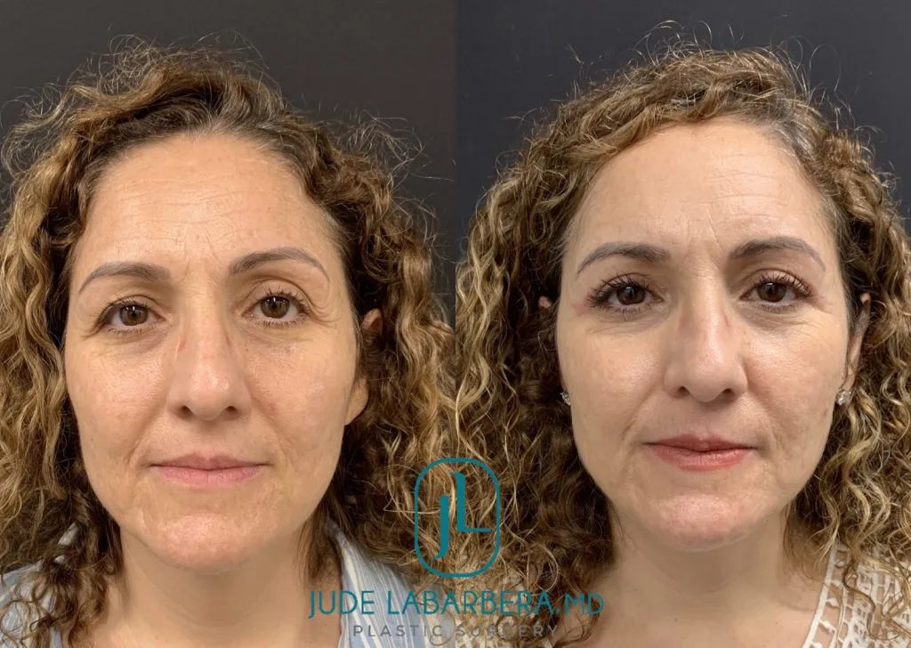 NATURAL RESULT AFTER UPPER EYELID LIFT – UPPER BLEPHAROPLASTY Before & After Case Number 00017