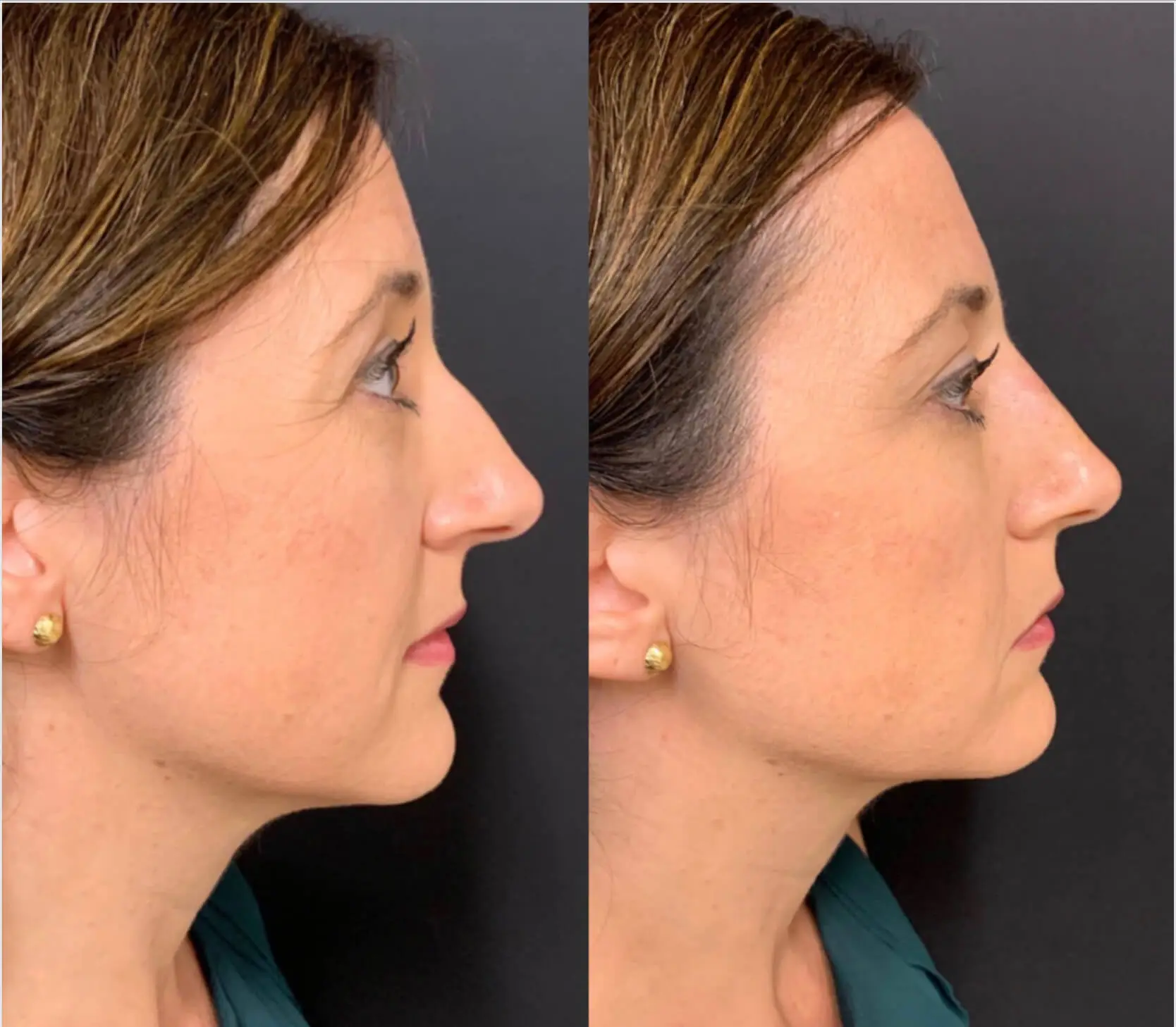 NON-SURGICAL RHINOPLASTY Before & After Case Number 0006
