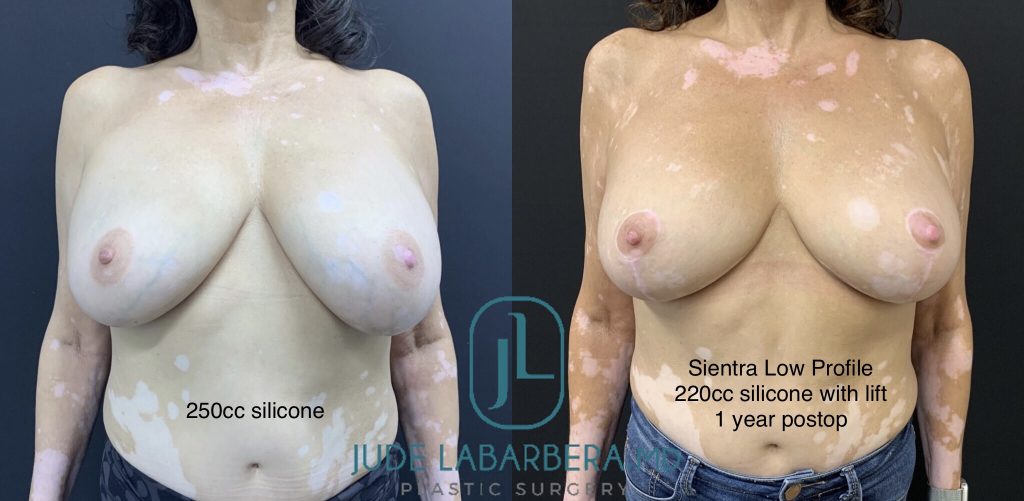 REVISION BREAST SURGERY Before & After Case Number 0003