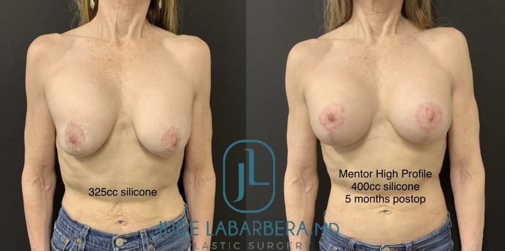 REVISION BREAST SURGERY Before & After Case Number 0004