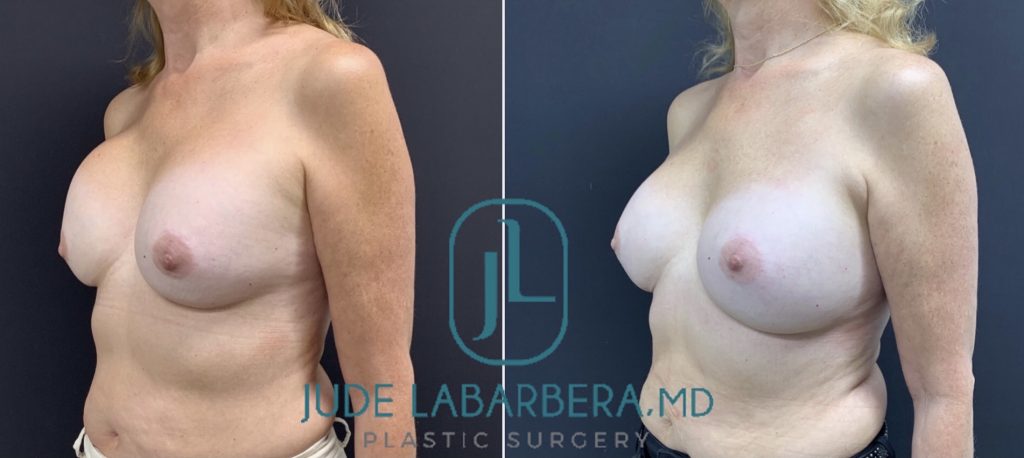 REVISION BREAST SURGERY Before & After Case Number 0005