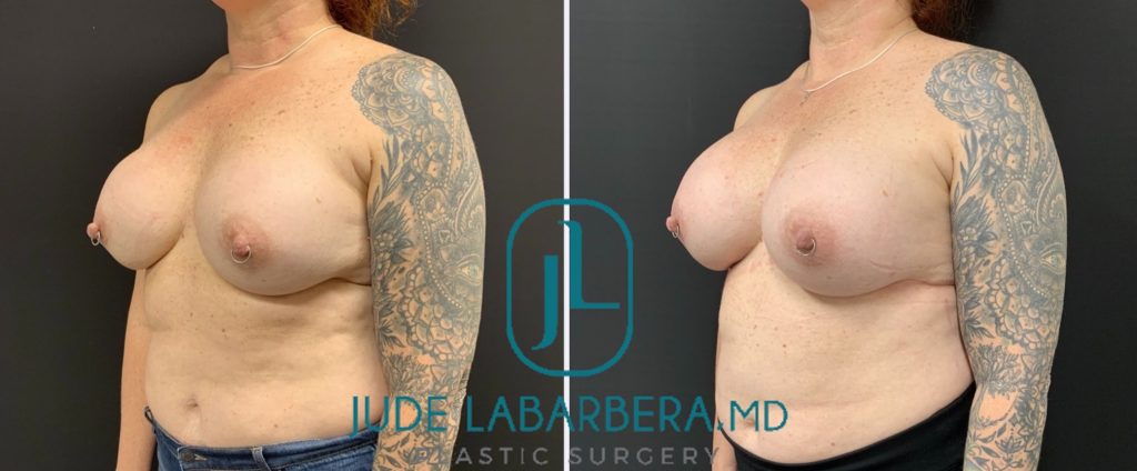 REVISION BREAST SURGERY Before & After Case Number 0007