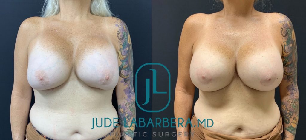 REVISION BREAST SURGERY Before & After Case Number 0009
