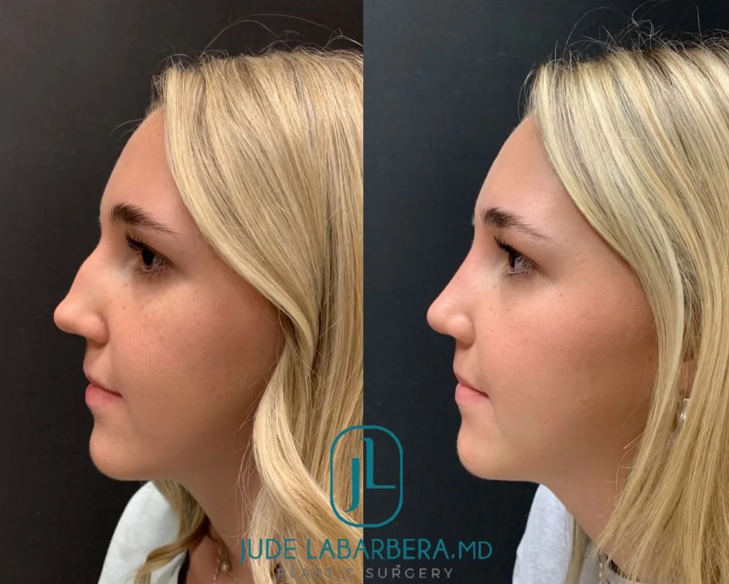RHINOPLASTY Before & After Case Number 0004