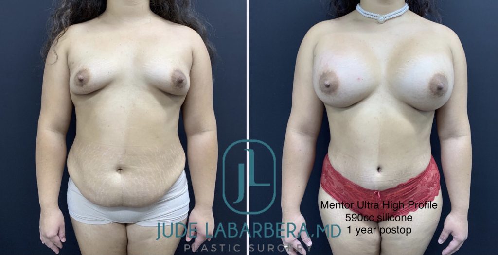STUNNING MOMMY MAKEOVER Before & After Case Number 00065