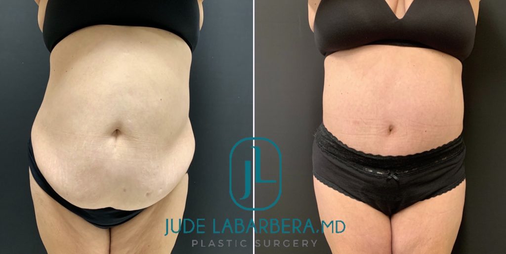 Tummy Tuck Before & After Case Number 00012