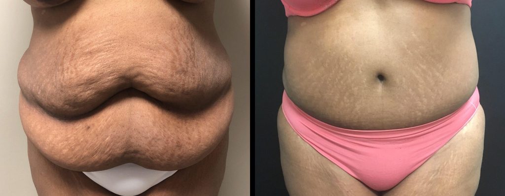 Tummy Tuck Before & After Case Number 00030