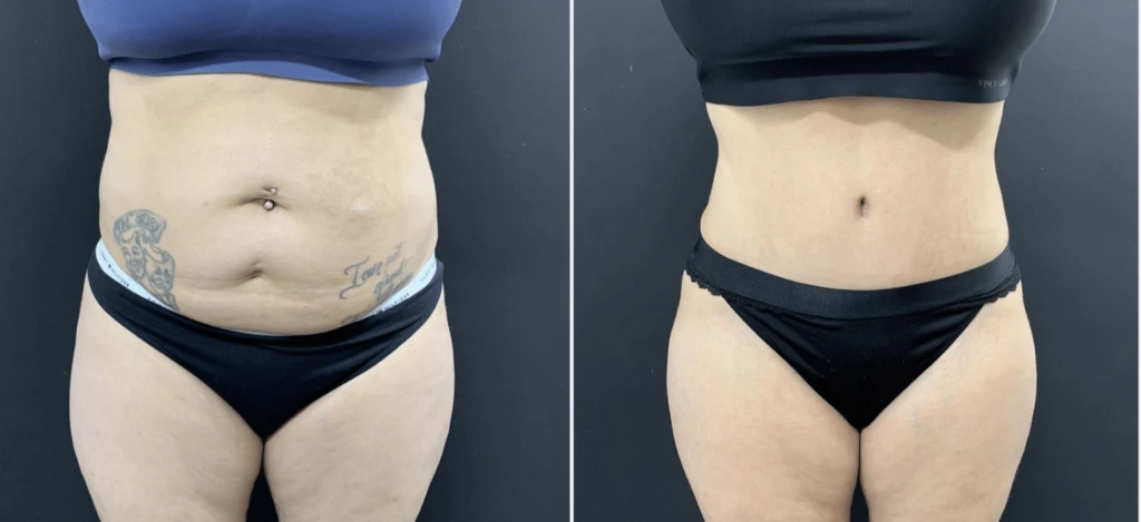 Tummy Tuck Before & After Case Number 0004