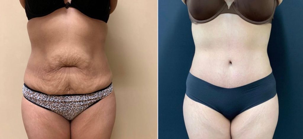 TUMMY TUCK Before & After Case Number 00059