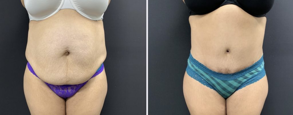 TUMMY TUCK Before & After Case Number 00064