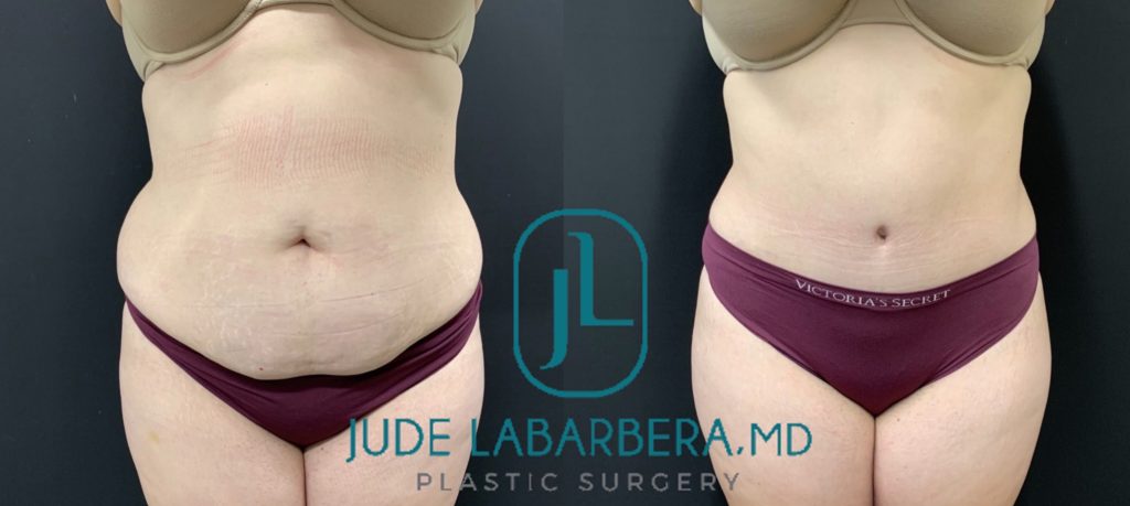 TUMMY TUCK Before & After Case Number 00079