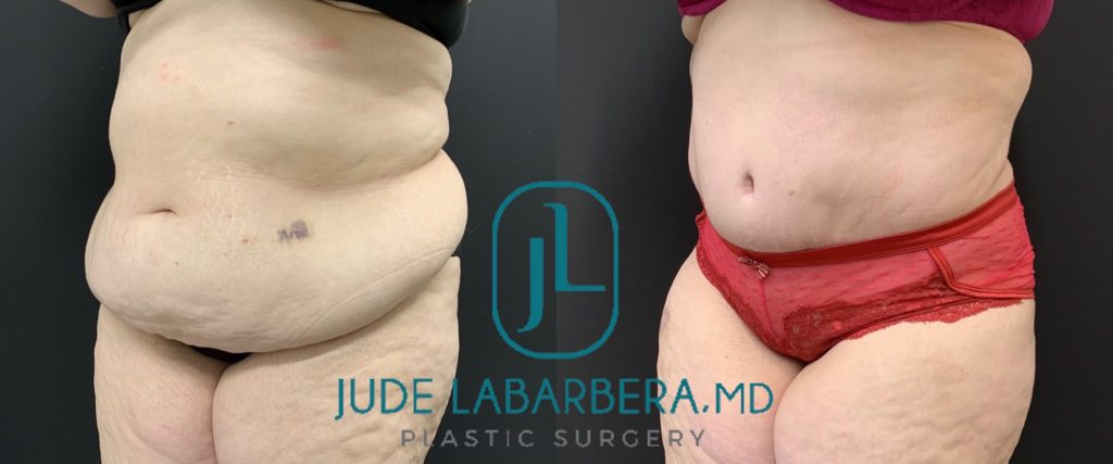 TUMMY TUCK Before & After Case Number 00089
