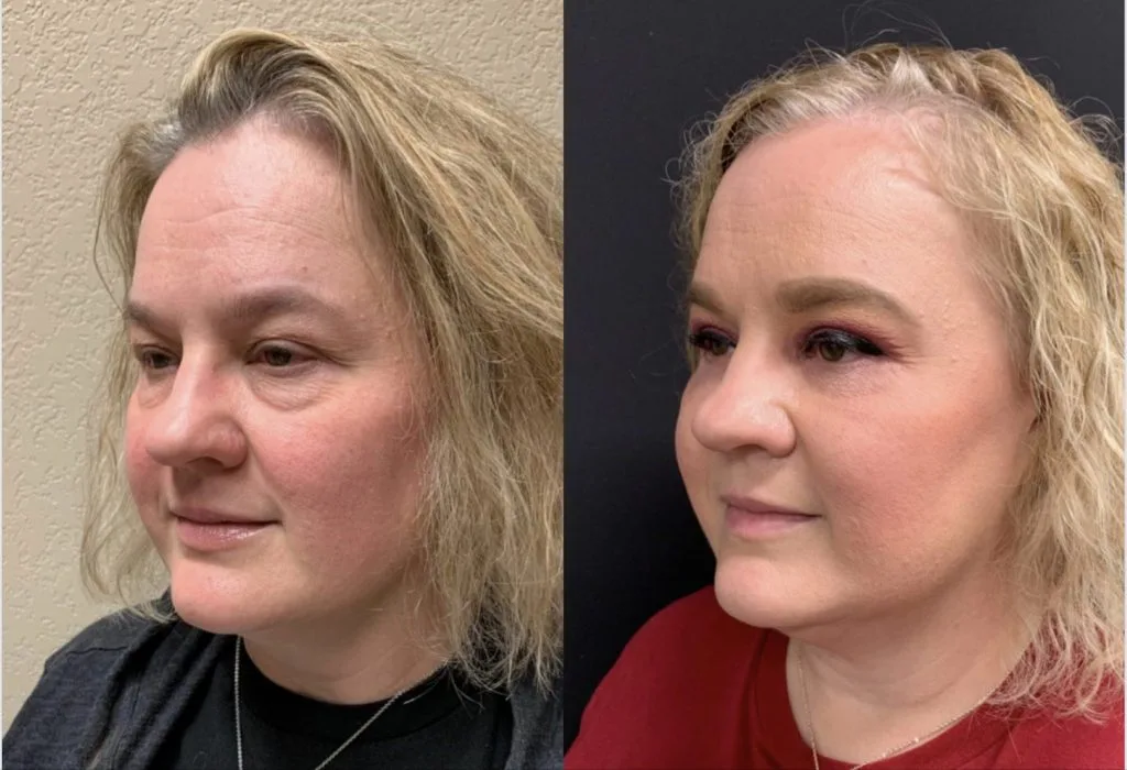 UPPER AND LOWER EYELID SURGERY Before & After Case Number 0005