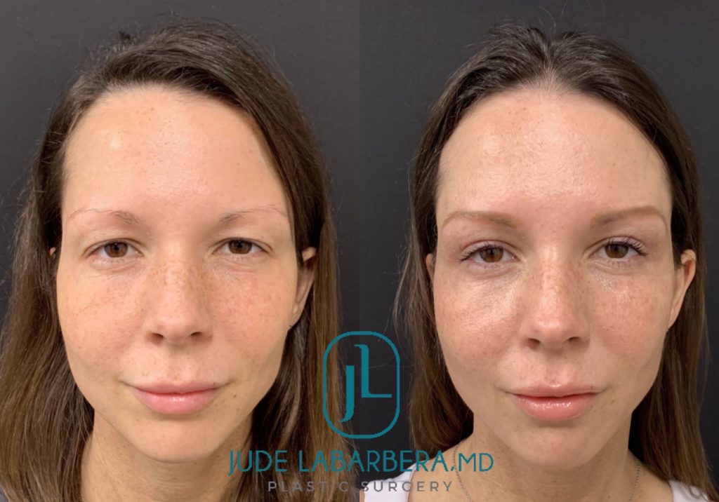 Upper EYELID Lift Before & After Case Number 00015