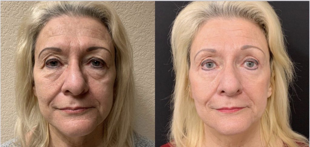 UPPER EYELID LIFT BY ANOTHER SURGEON ALONG WITH LOWER EYELID LIFT (BLEPHAROPLASTY) Before & After Case Number 0006