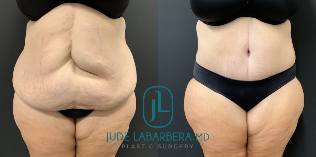 High-BMI Tummy Tuck Before & After Case Number 000117