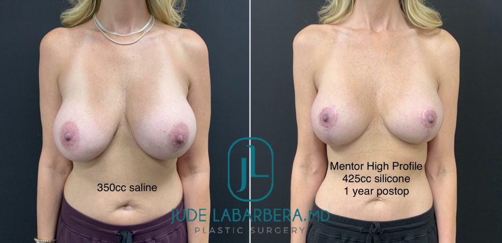 Long Term Results Breast Aug with Lift & Breast Revision Before & After Case Number 00074