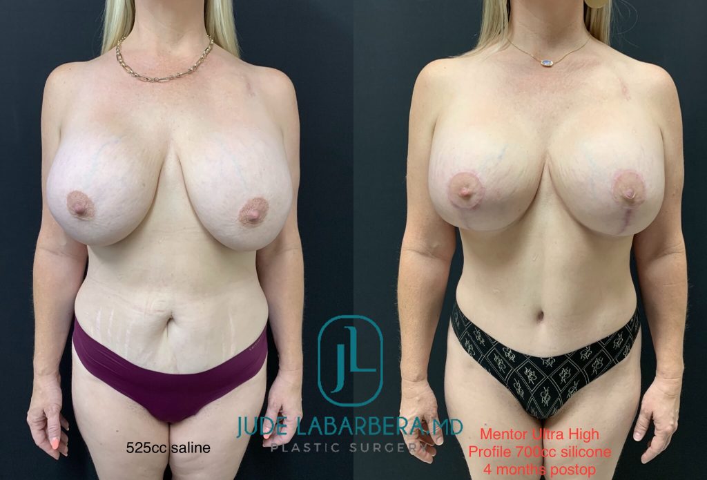 Mommy Makeover before & after Case 006