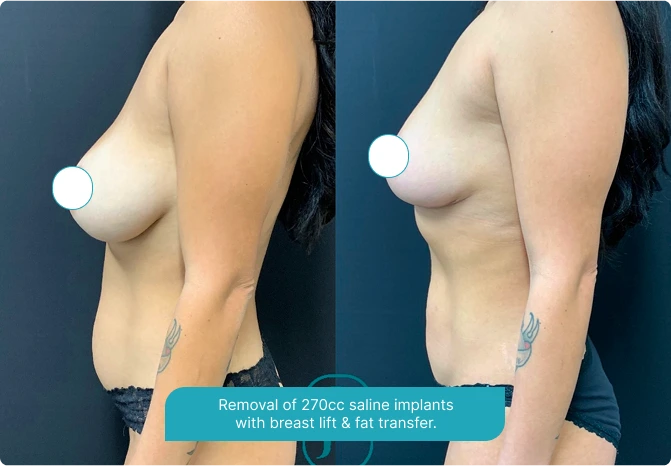 Fat Transfer Breast Augmentation in Scottsdale, AZ: Before & After Gallery Banner