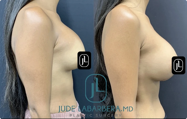 Before and After Gallery: Breast Fat Transfer