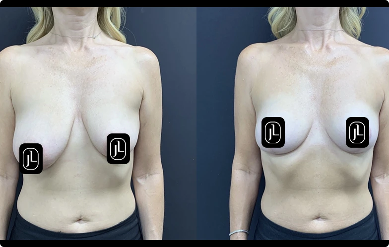 Before and After Gallery: Breast Fat Transfer